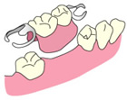 部分入れ歯
