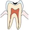 C1【エナメル質の虫歯】