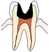 C3【神経まで進んだ虫歯】
