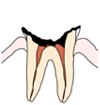 C4【歯根まで進んだ虫歯】
